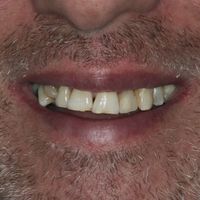 Dental Veneers - Smile 5 before